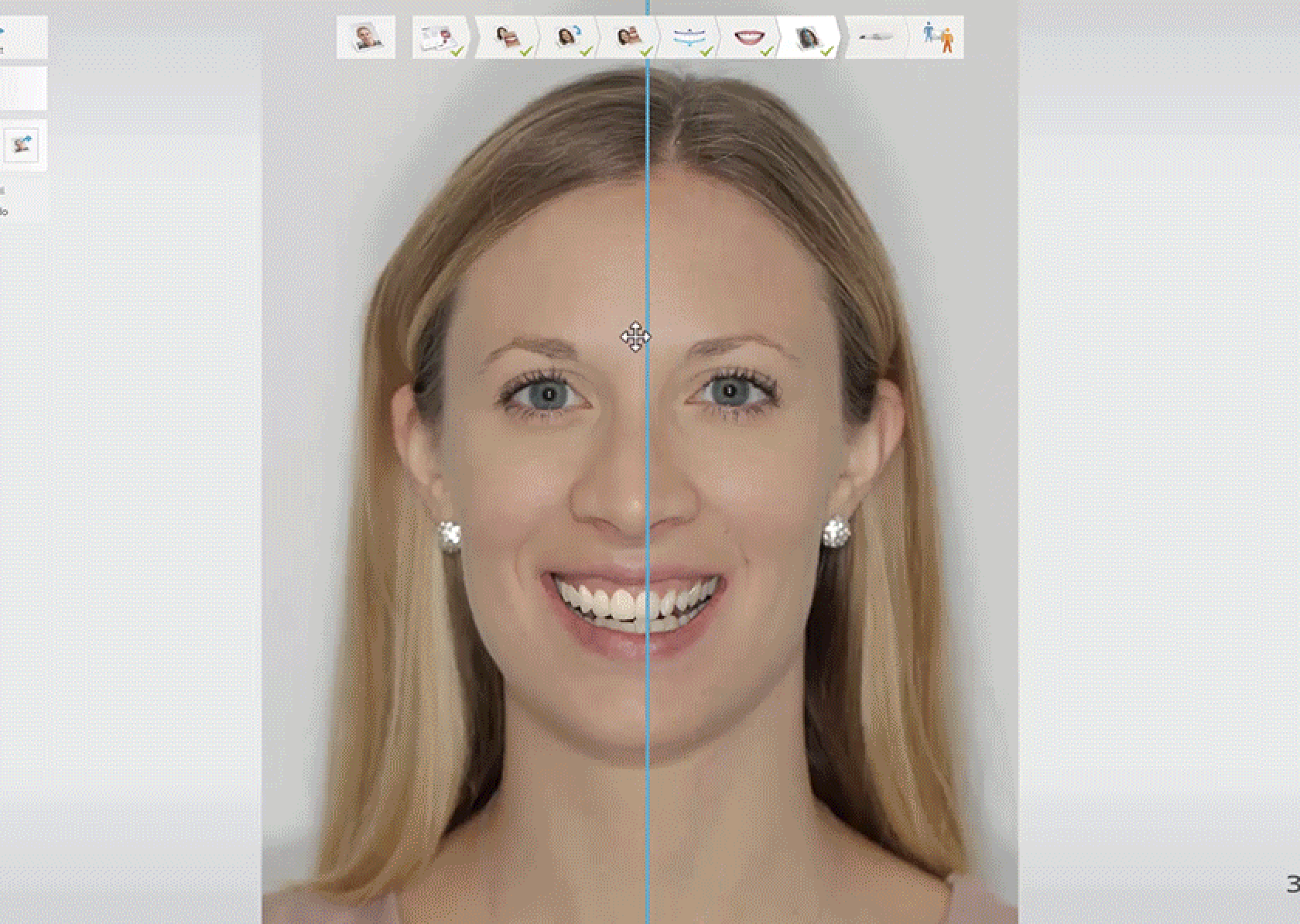 A gif showing different parts of the smile makeover process, with before and after images of the clients face.